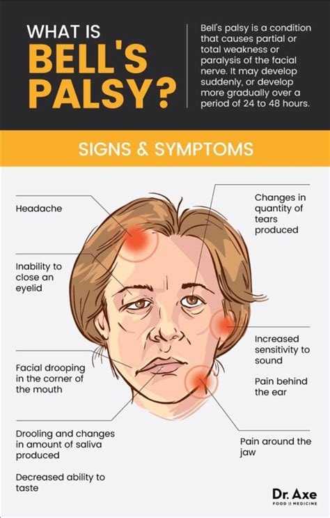 bell palsy symptoms